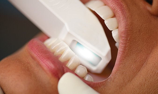 close up of iTero scanning patients lower jaw to render teeth alignment