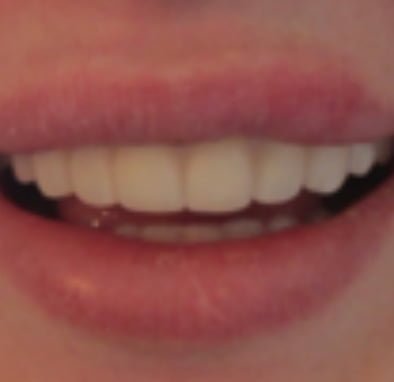 Smile before the smile makeover treatment